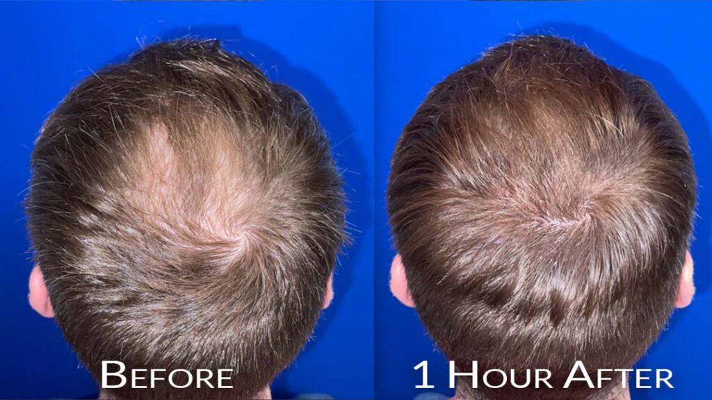 antes y después de micropigmentación capilar Chicago IL