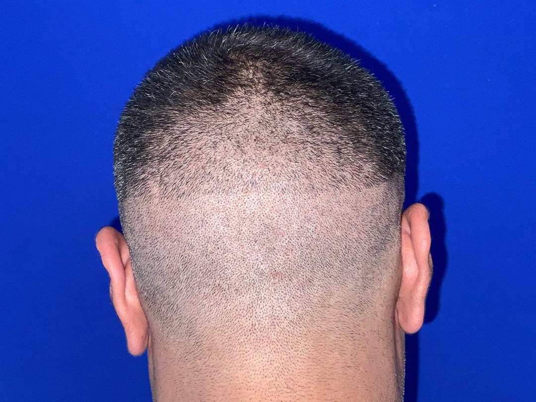 vinay-donor-before