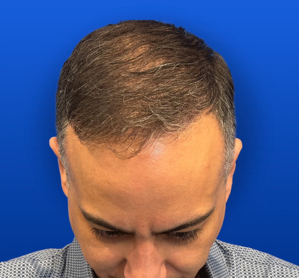 Men's Surgical Hair Restoration