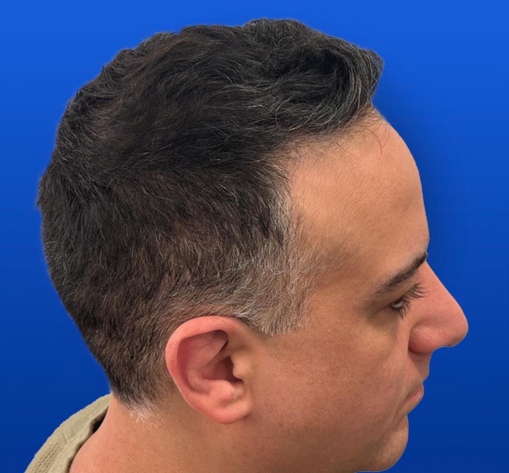 Men's Surgical Hair Restoration