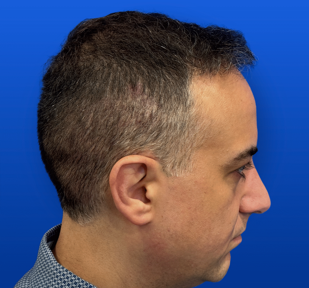 Men's Surgical Hair Restoration