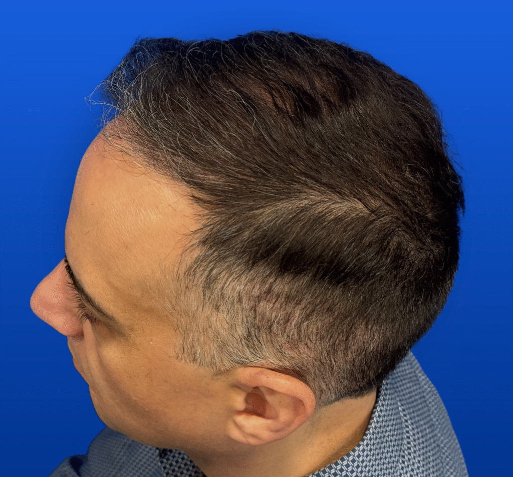 Men's Surgical Hair Restoration