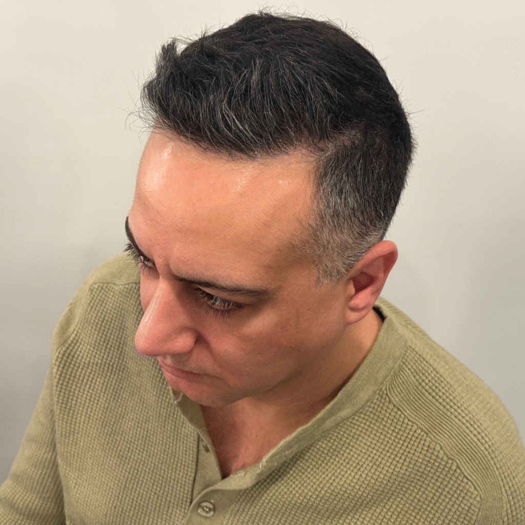 Hair Transplant Before And After Chicago