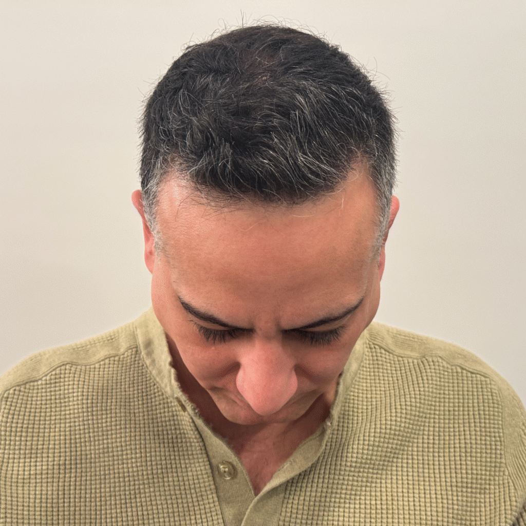 Hair Transplant Before And After Chicago