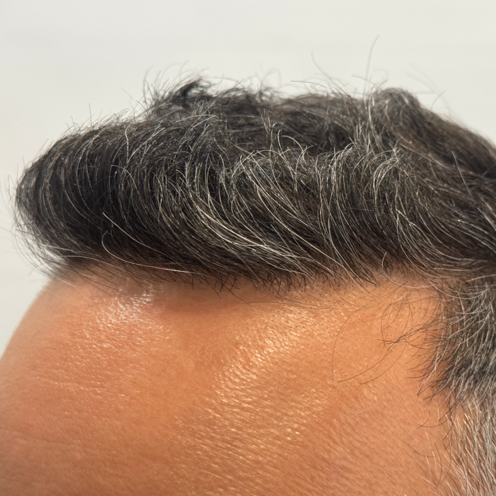 Hair Transplant Before And After Chicago
