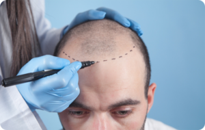 Can You Style Your Hair After a Hair Transplant