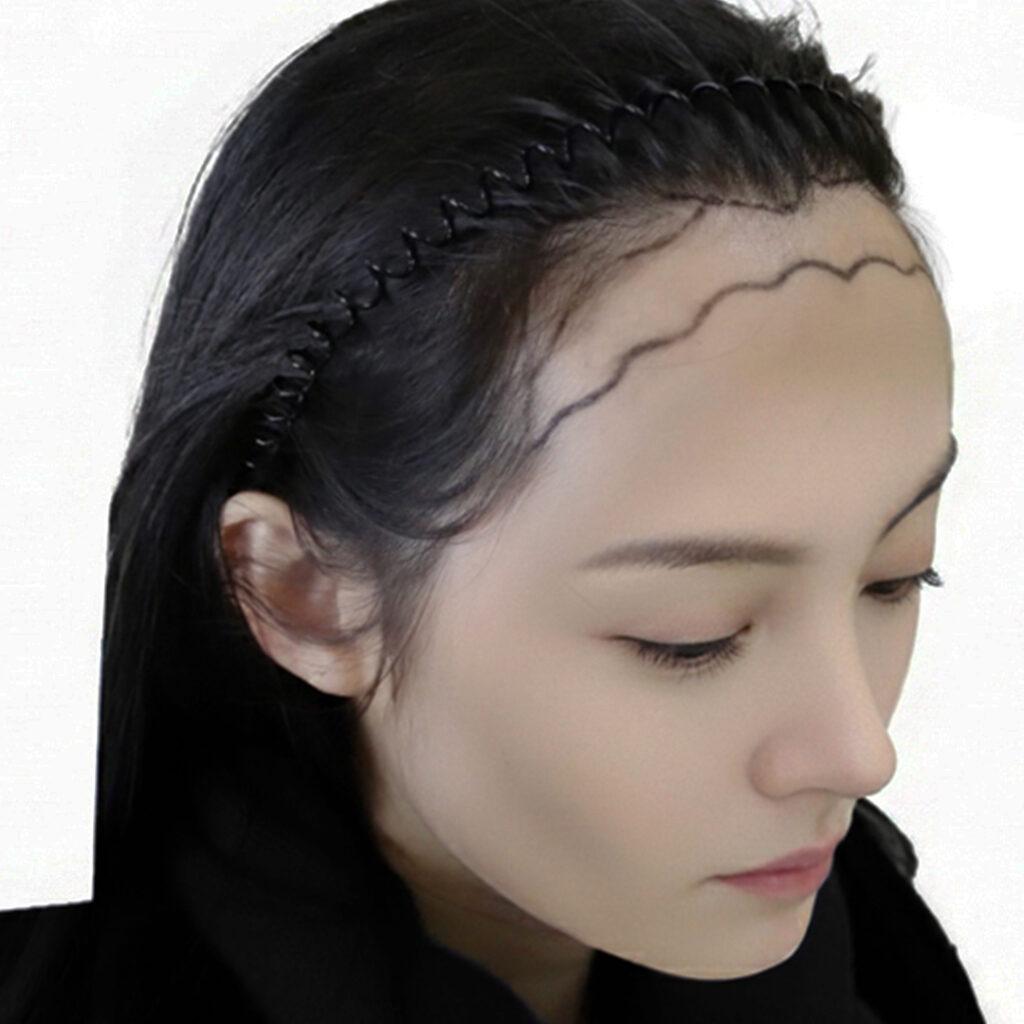 Hair Restoration In Cook County