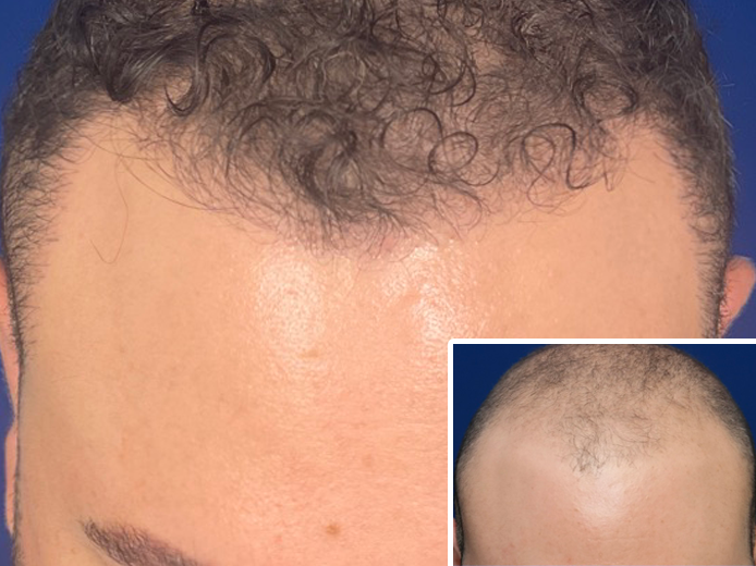 Hair Transplantation Procedures Work Effectively | Northwestern Hair Restoration